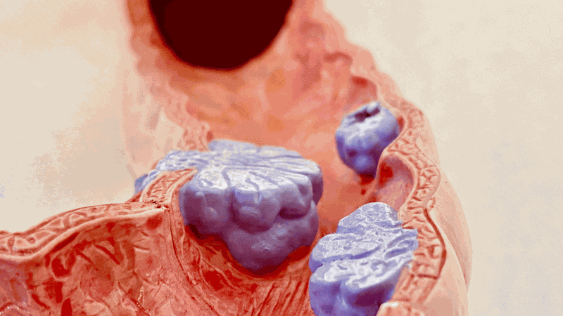 Viêm đại tràng xuất huyết là gì? Dấu hiệu nhận biết 4