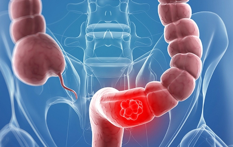 Viêm đại tràng xung huyết có những triệu chứng gì1