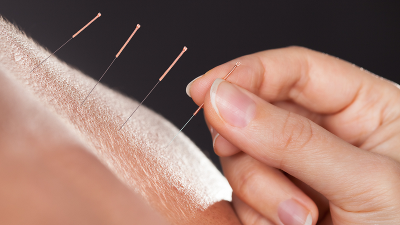 Việc châm những kim mảnh vào các huyệt đạo có thể giúp giảm các triệu chứng