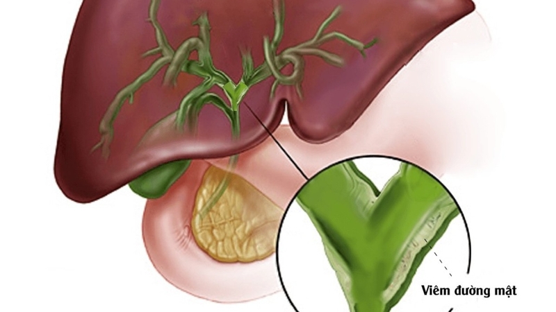 Viêm đường mật: Nguyên nhân, triệu chứng và cách phòng ngừa bệnh hiệu quả 1
