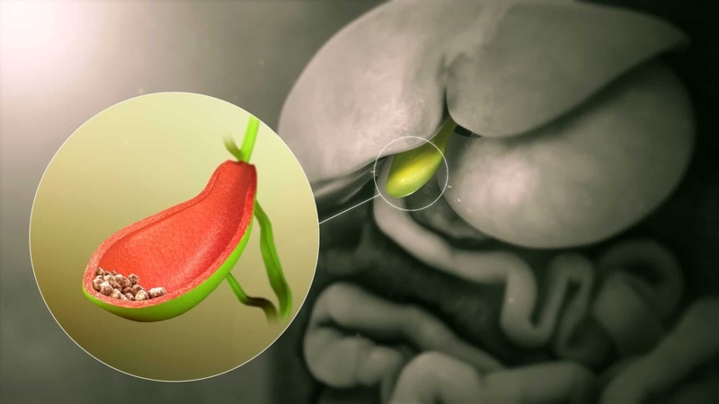 Viêm đường mật: Nguyên nhân, triệu chứng và cách phòng ngừa bệnh hiệu quả 3