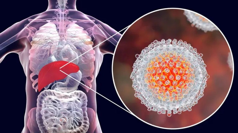Viêm gan B cấp (B16) là giai đoạn nhiễm virus HBV mới xảy ra
