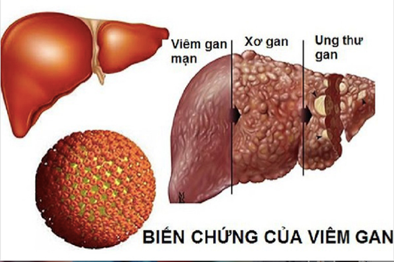 Viêm gan B mạn tính có lây không? Có trị dứt điểm được không? 3