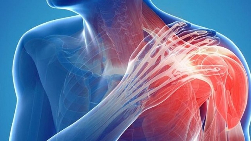 Viêm gân cơ trên gai: Nguyên nhân, triệu chứng, chẩn đoán và điều trị 1
