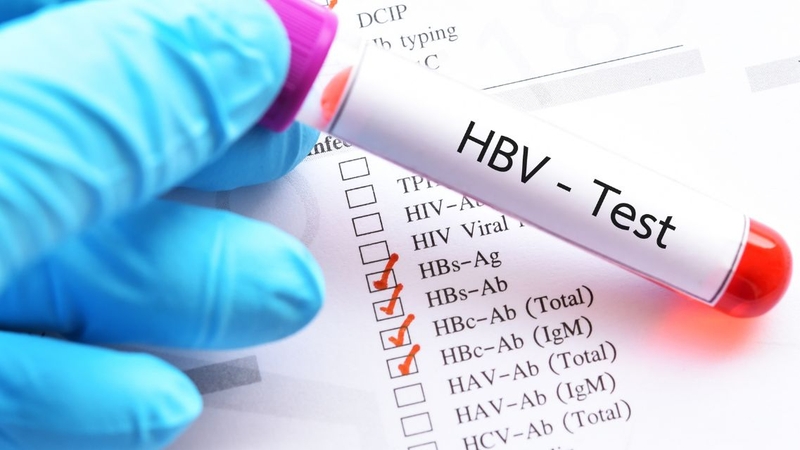 Xét nghiệm HBsAg và HBV-DNA giúp chẩn đoán viêm gan B mạn tính