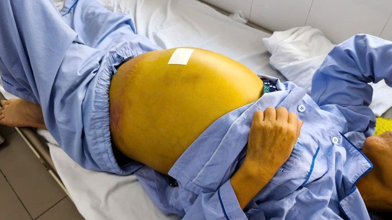 Phát hiện sớm và điều trị đúng cách giúp cải thiện tiên lượng cho người bị viêm gan tối cấp