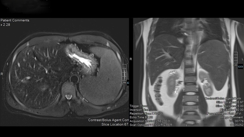 Viêm gan ứ sắt là bệnh gì? Nguyên nhân, dấu hiệu và cách phòng ngừa 3