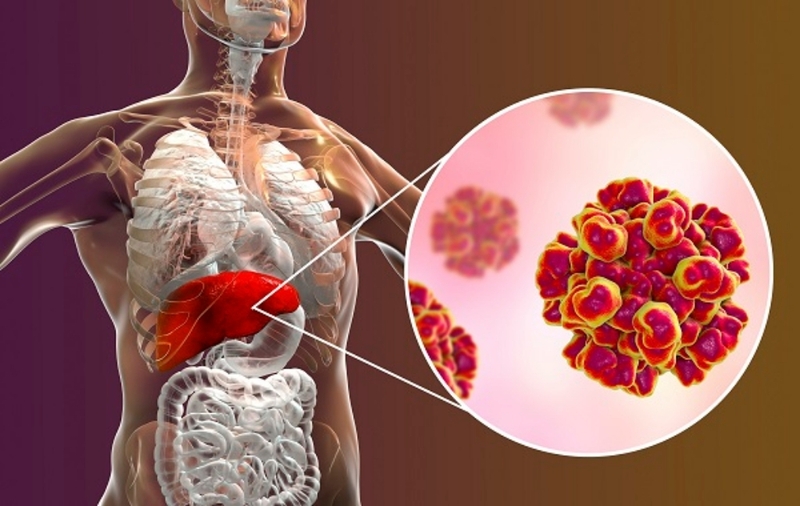 Viêm gan virus mạn là gì? Nguyên nhân và triệu chứng của viêm gan virus mạn 1