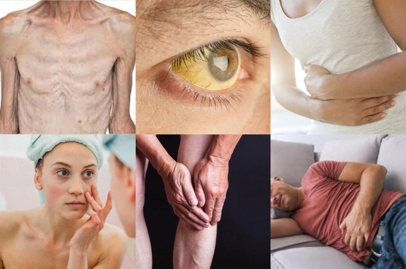 Viêm gan virus mạn là gì? Nguyên nhân và triệu chứng của viêm gan virus mạn 2