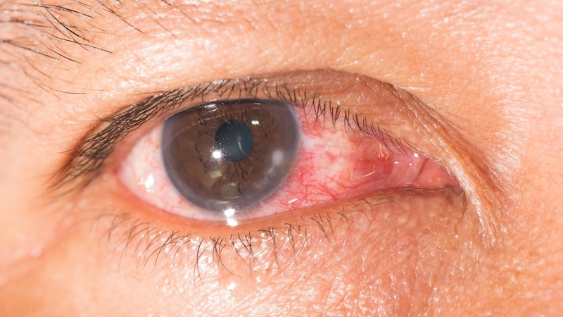 viem-giac-mac-co-nguy-hiem-khong-nhung-dieu-ban-can-biet 1