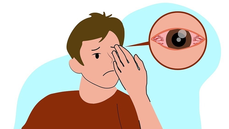 Viêm giác mạc dùng thuốc gì? 1