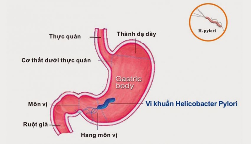 Viêm hang vị dạ dày có nguy hiểm không và cách điều trị hiệu quả 1