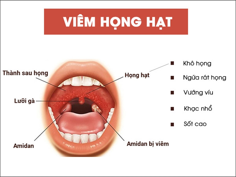 Cách chữa viêm họng hạt có mủ