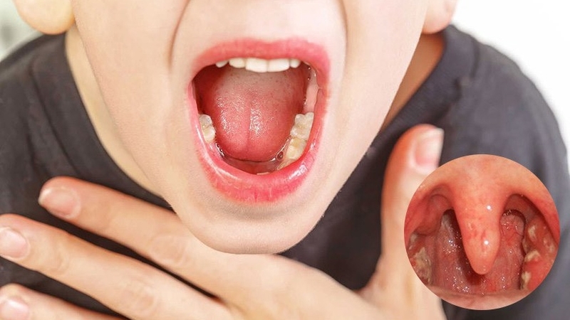 Viêm họng kéo dài mãi không dứt nguyên nhân do đâu? 4