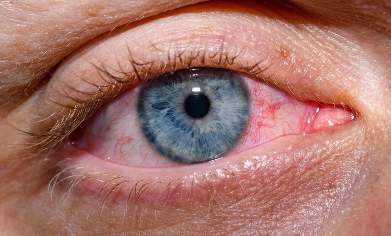 Viêm kết giác mạc cấp: Nguyên nhân, triệu chứng, chẩn đoán và điều trị 1
