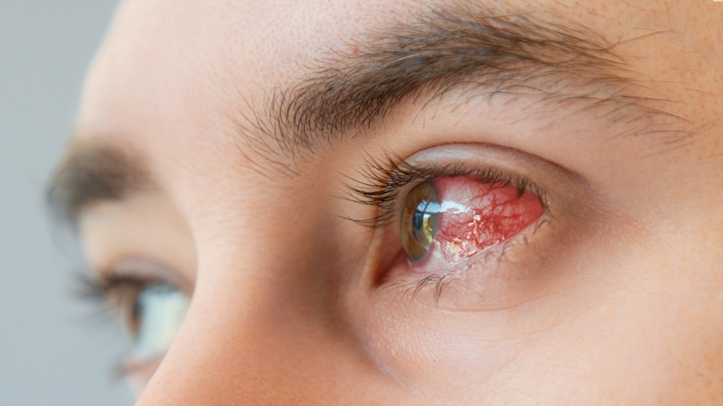 Viêm kết mạc cấp: Nguyên nhân, triệu chứng và điều trị 2