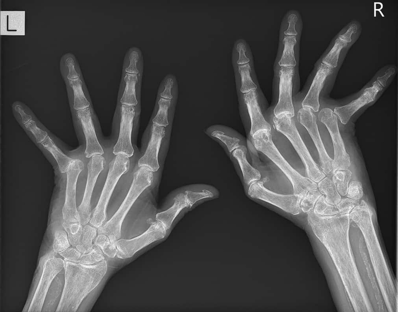 Viêm khớp dạng thấp là gì? Những biến chứng viêm khớp dạng thấp có thể bạn chưa biết 2