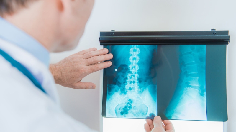 Viêm khớp đốt sống là gì? Những vấn đề cần biết về bệnh lý viêm khớp đốt sống 5