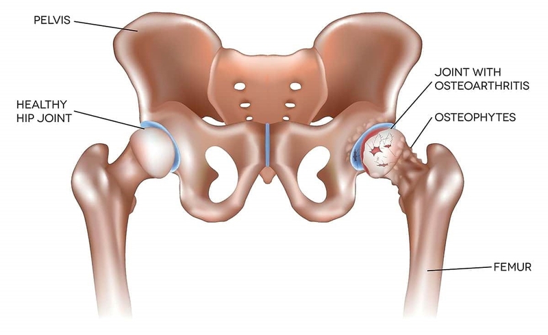 Viêm khớp háng là gì? Những vấn đề cần biết về bệnh lý viêm khớp háng 4