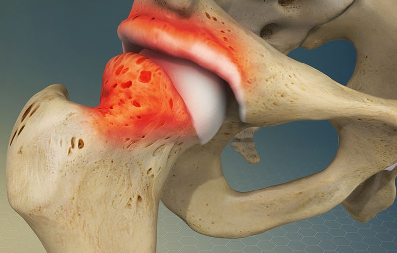 Viêm khớp háng nên uống thuốc gì? Các cách chữa trị viêm khớp háng hiệu quả 1