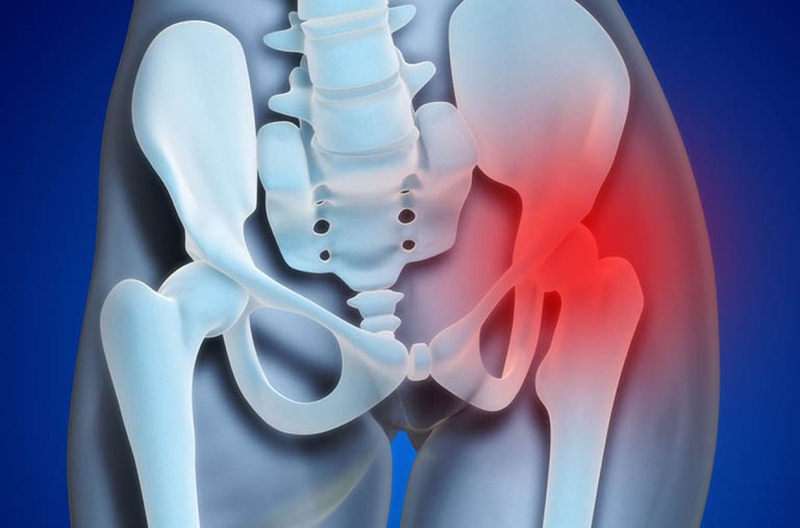 Viêm khớp háng tràn dịch: Nguyên nhân, triệu chứng, cách điều trị1