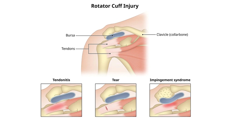 Viêm khớp vai là gì? Tìm hiểu về 5 loại viêm khớp vai thường gặp 7