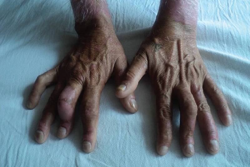 Viêm khớp vảy nến ảnh hưởng như thế nào đến sức khoẻ của người bệnh? 2