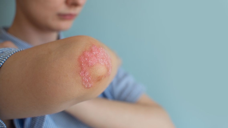 Viêm khớp vảy nến không thể chữa khỏi vĩnh viễn cho mọi bệnh nhân