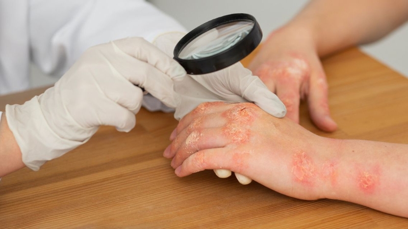 Điều trị căn bệnh này tập trung vào mục tiêu giảm nhẹ triệu chứng