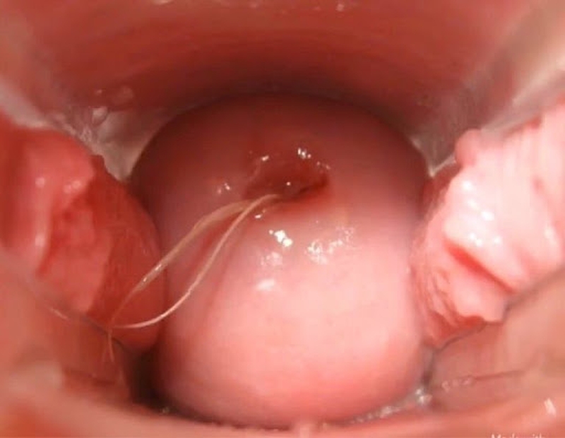 Những điều bạn nên biết về bệnh viêm  lộ tuyến cổ tử cung sau sinh 1