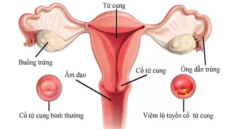 Viêm lộ tuyến tử cung - Biểu hiện và cách điều trị như thế nào? 1