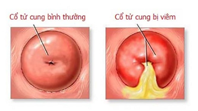 Viêm lộ tuyến cổ tử cung có tự khỏi không? Lưu ý để mau chóng khỏi bệnh 3