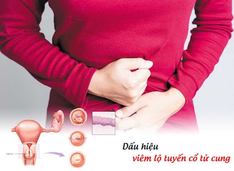 Viêm lộ tuyến tử cung - Biểu hiện và cách điều trị như thế nào? 3