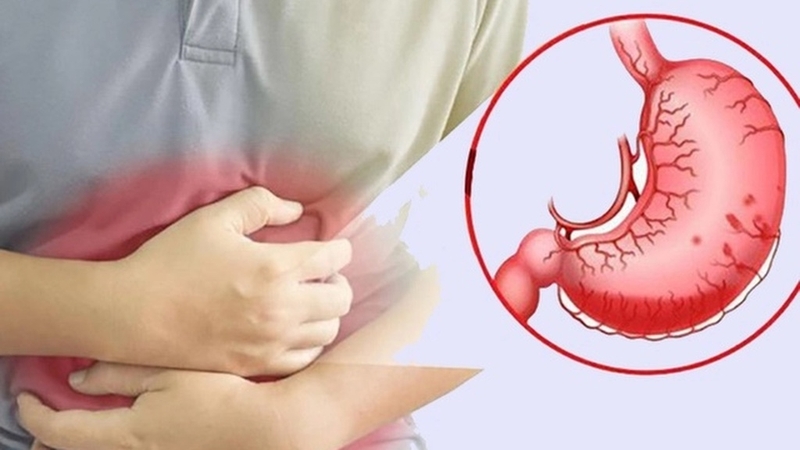 Viêm loét dạ dày do khuẩn HP và những biến chứng nguy hiểm 3