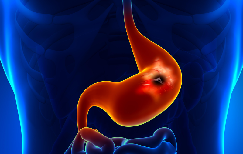 Viêm loét dạ dày nặng gây ra những biến chứng như thế nào?1