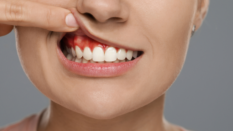 Viêm lợi có mủ: Nguyên nhân, triệu chứng và cách điều trị hiệu quả 2