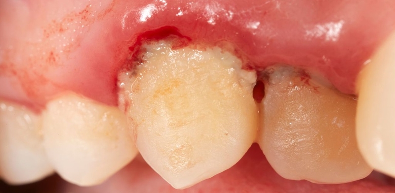 Viêm lợi loét hoại tử cấp: Nguyên nhân, triệu chứng, biến chứng và điều trị 1