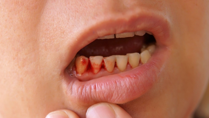 Viêm lợi loét hoại tử cấp: Nguyên nhân, triệu chứng, biến chứng và điều trị 2