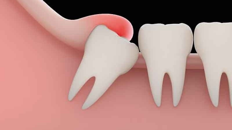 viem-loi-trum-co-mu-dau-hieu-va-huong-dan-dieu-tri-1