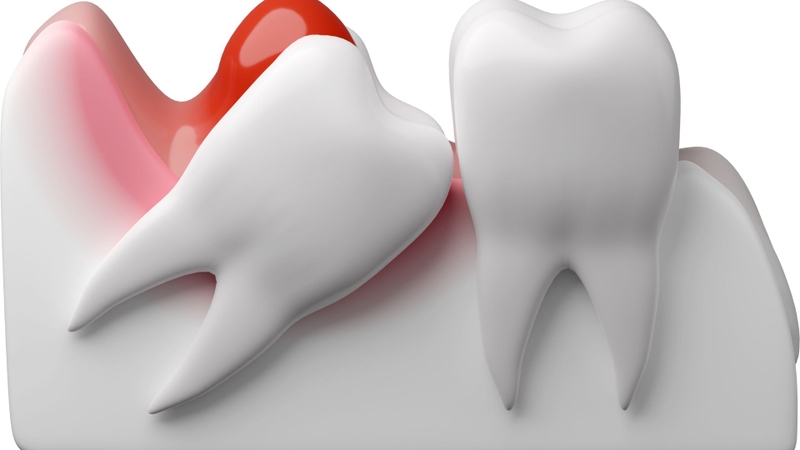 Nướu răng sưng to và đỏ là dấu hiệu của viêm lợi trùm