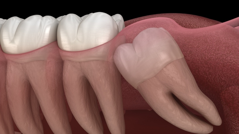 Viêm lợi trùm răng khôn khi mang thai - Xử lý sao cho đúng cách? 1