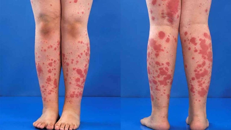 Viêm mạch máu là gì? Nguyên nhân và cách điều trị bệnh 1