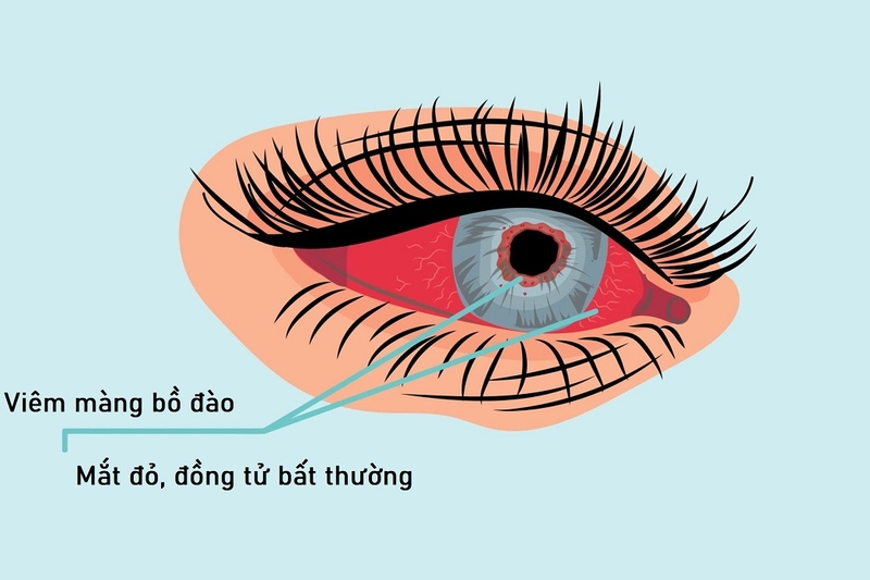 Điều trị viêm màng bồ đào bao lâu thì khỏi 1