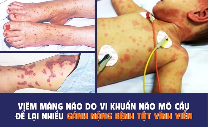 viêm màng não mô cầu acyw 1