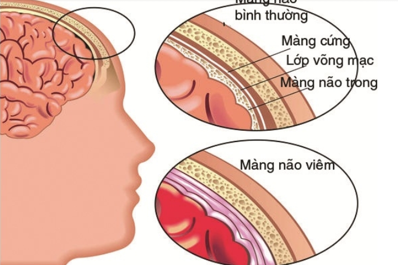 Bệnh viêm màng não mủ là gì?
