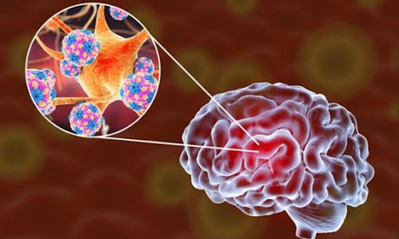 viêm màng não do lao 1