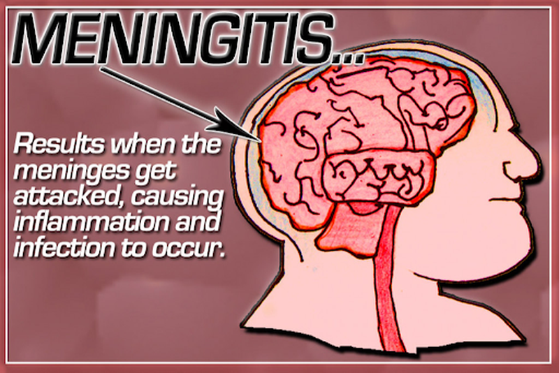 viêm màng não do lao 3