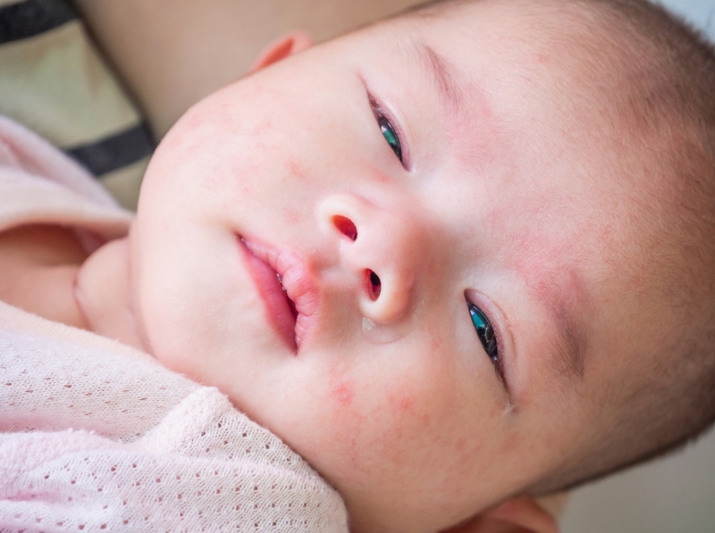 Viêm màng não nhiễm khuẩn ở trẻ sơ sinh trên 3 tháng tuổi 1