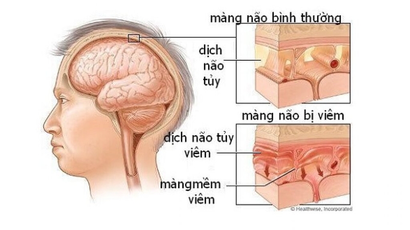 Viêm màng não ở người lớn có nguy hiểm không, triệu chứng thế nào? 1