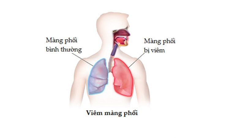 Viêm màng phổi là bệnh gì có nguy hiểm không 2